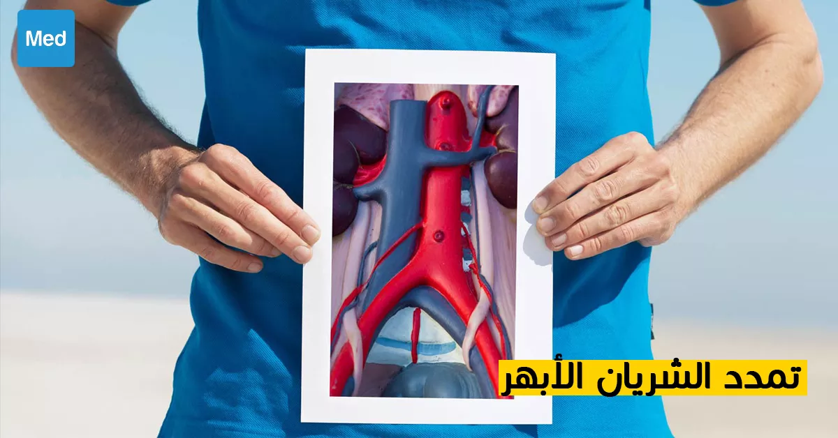 تمدد الشريان الأبهر